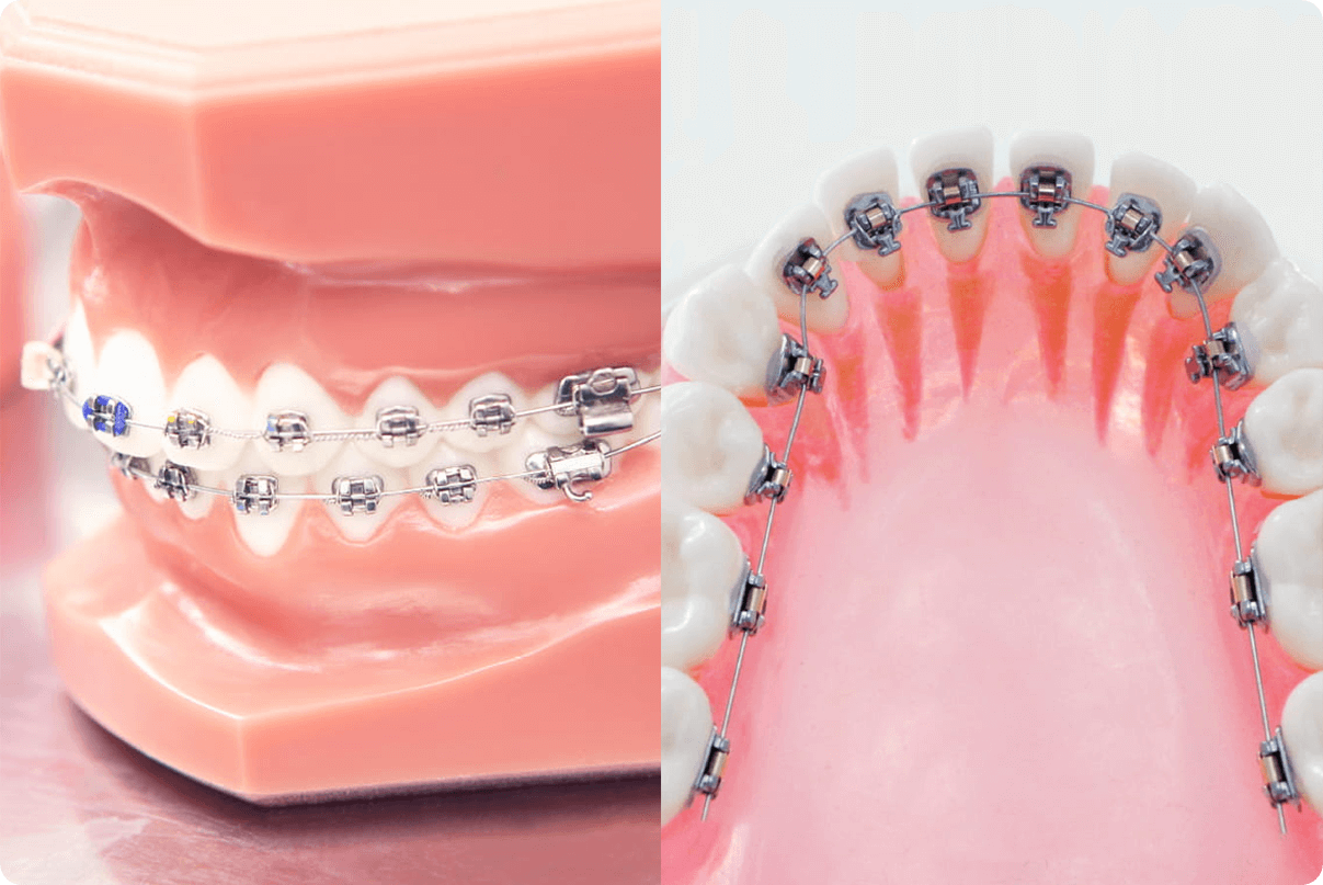 ほとんどの歯列に対応できて、確実性が高いブラケット矯正