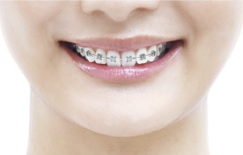 メタルブラケット