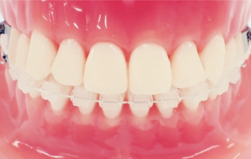 ハーフクリアブラケット