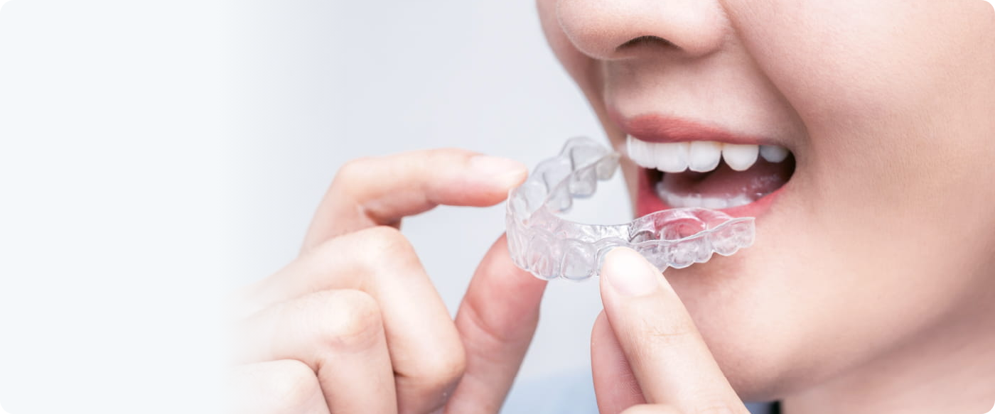 着脱できて、目立たないマウスピース矯正