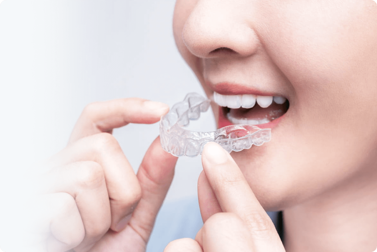 着脱できて、目立たないマウスピース矯正
