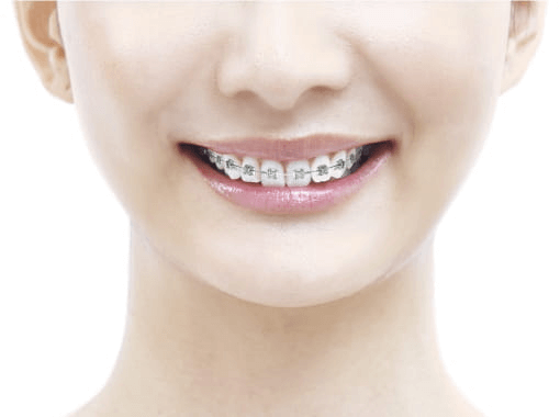 メタルブラケット