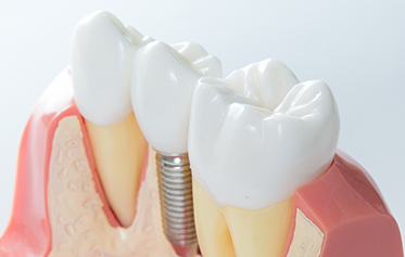 隣の歯に負担をかけない