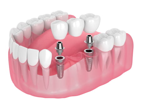 インプラント+ブリッジ