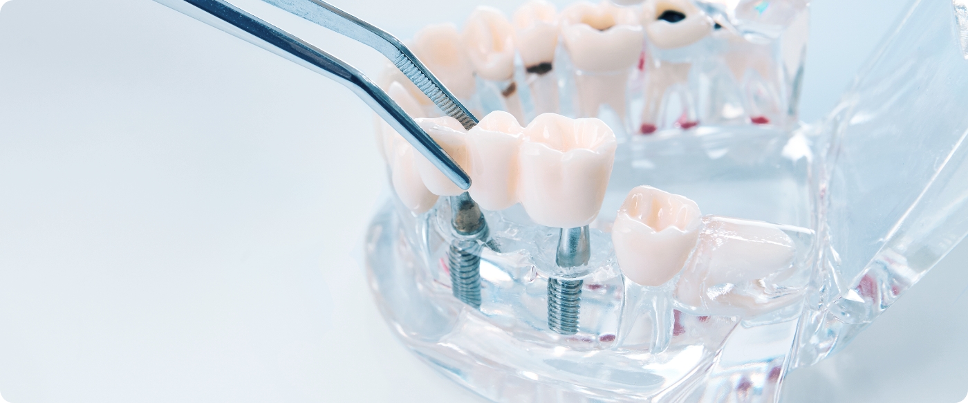 インプラント治療は、今では一般的な歯科治療の選択肢の一つです。